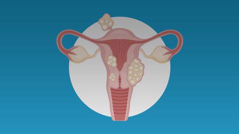 Optimizing Medical Management of Uterine Fibroids: Achieving Patient-Centered Goals and Outcomes