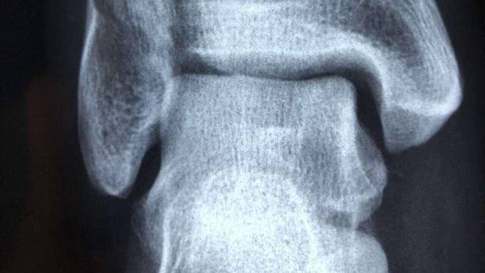 Acid Reflux Drugs Linked to Increased Fracture Risk in Kids