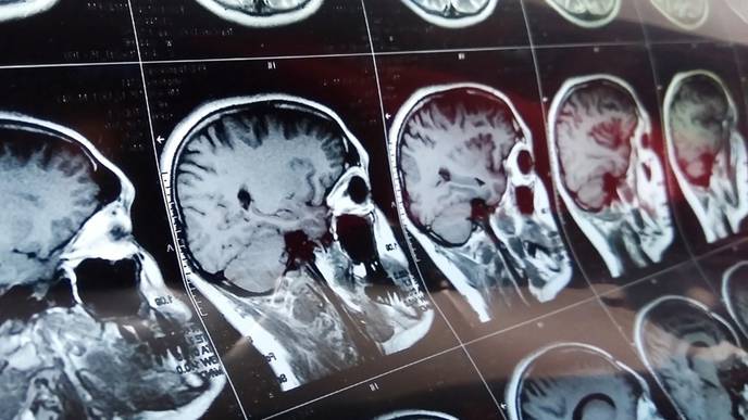Stroke Patients with COVID-19 Have Increased Systemic Inflammation