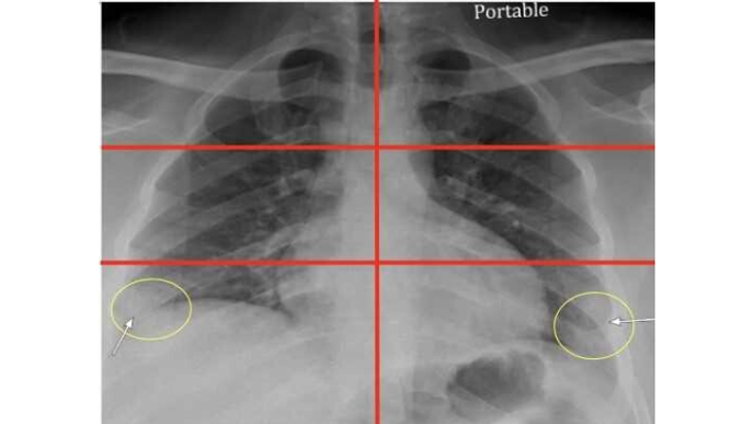 Chest X-Rays in Emergency Rooms Can Help Predict Severity of COVID-19 Illness in Young & Middle-Aged Adults