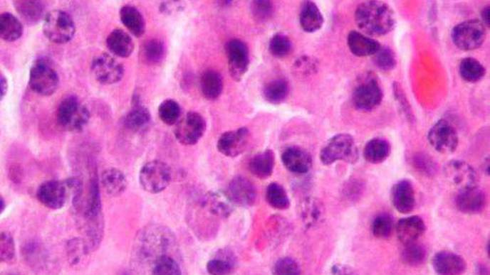 Promising Results Could Pave Way for New Multiple Myeloma Drug