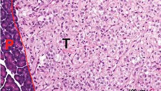 Where Cancers Go Could Guide Their Treatment