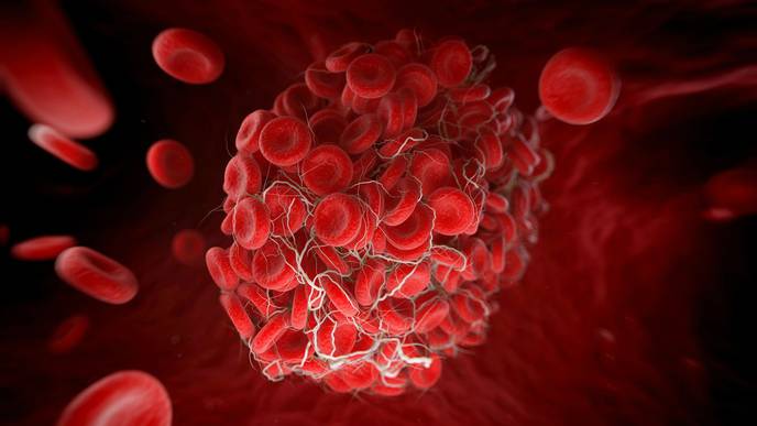 COVID-19 May Cause Deadly Blood Clots