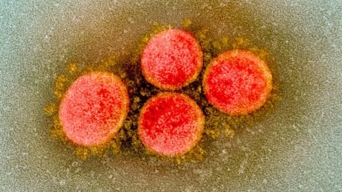 COVID-19 Patients May Have Lower Stroke Rates Than Previously Suggested