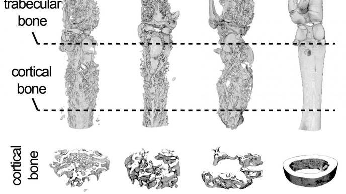 Drug Doubles Down on Bone Cancer and Metastasis