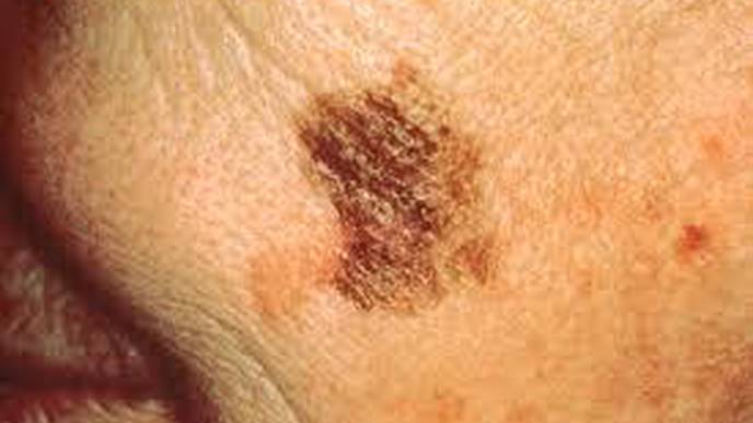 Skin Cancer: Men Are Genetically More Prone
