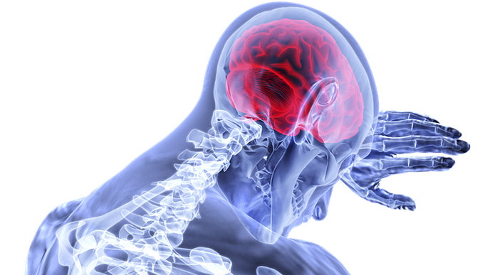 Stroke Scans Could Reveal COVID-19 Infection