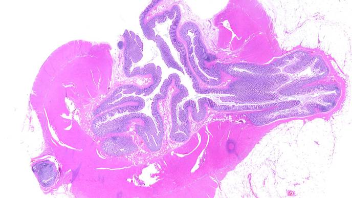 Editorial Calls for a Precision Medicine Approach to Follow-Up of Diverticulitis