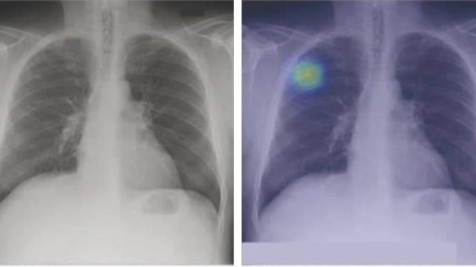 New Lung Cancer-Detecting AI Algorithm Shows Impressive Results