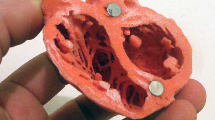 Women With CAD Have More Chest Pain, But Less Artery Narrowing Than Men