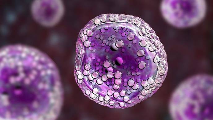 Combination of Low Muscle Mass & Density Associated with Shorter Survival in Lymphoma Patients