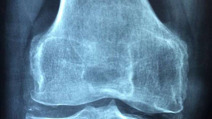 Study Shows Offspring Develop Normally in Mothers with Rheumatic Disease