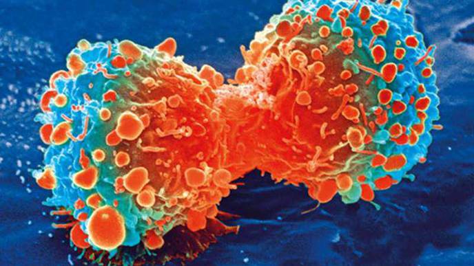 Largest Study of Prostate Cancer Genomics in Black Americans IDs Targets for Therapies