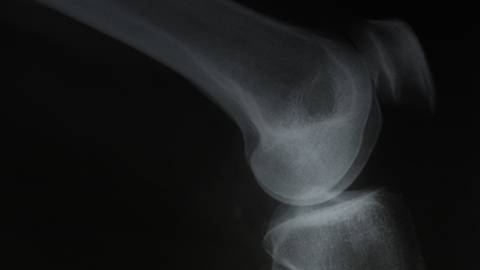 Shattering Myths About Osteoporosis