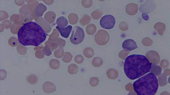 Blood Cancer Discovery Raises New Treatment Hopes
