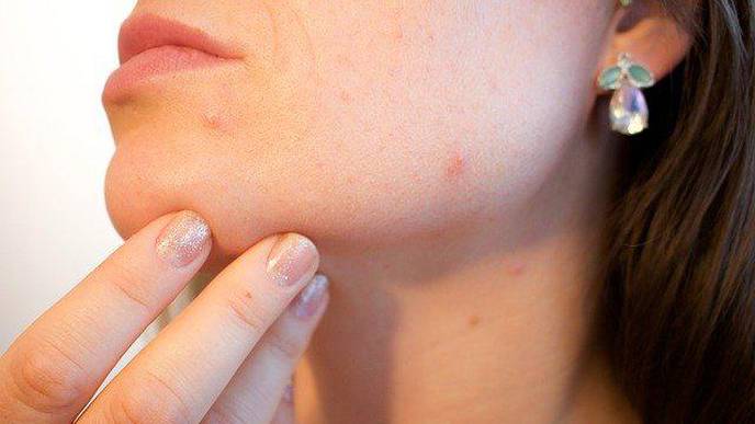 Chemical Reconstruction Plus Fractionated Nonablative Laser Improves Appearance of Acne Scars