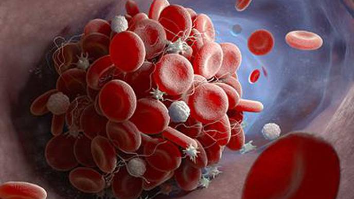 COVID-19 Causes Hyperactivity in Blood-Clotting Cells