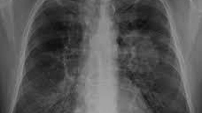 Chest X-rays Show More Severe COVID-19 in Non-white Patients