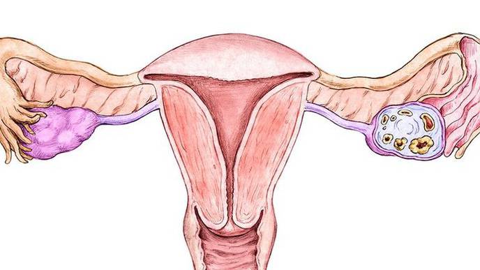 Obesity Increases Endometrial Cancer Risk